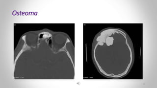 Osteoma
25
 