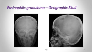 Eosinophilc granuloma – Geographic Skull
27
 