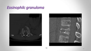 Eosinophilc granuloma
28
 