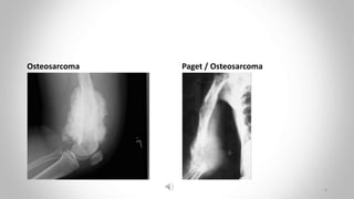 Osteosarcoma Paget / Osteosarcoma
6
 