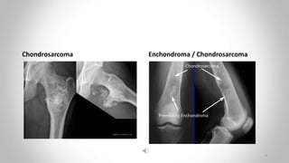 Chondrosarcoma Enchondroma / Chondrosarcoma
8
 