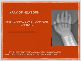 Bone age | PPTX