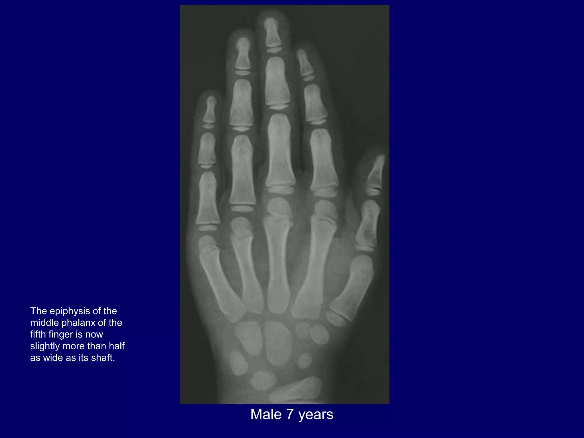 bone age .pptx