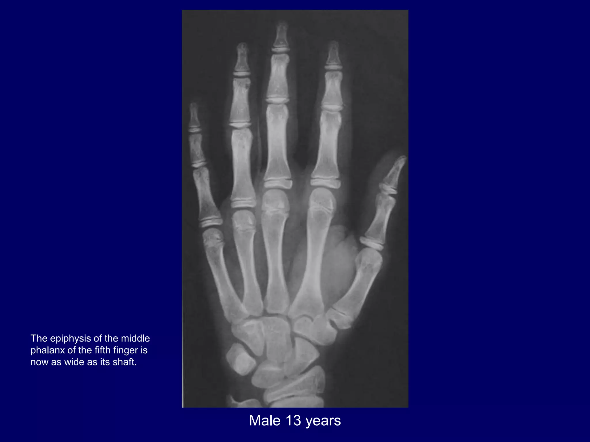 bone age .pptx