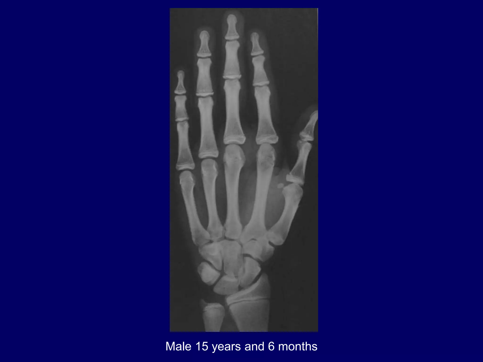 bone age .pptx