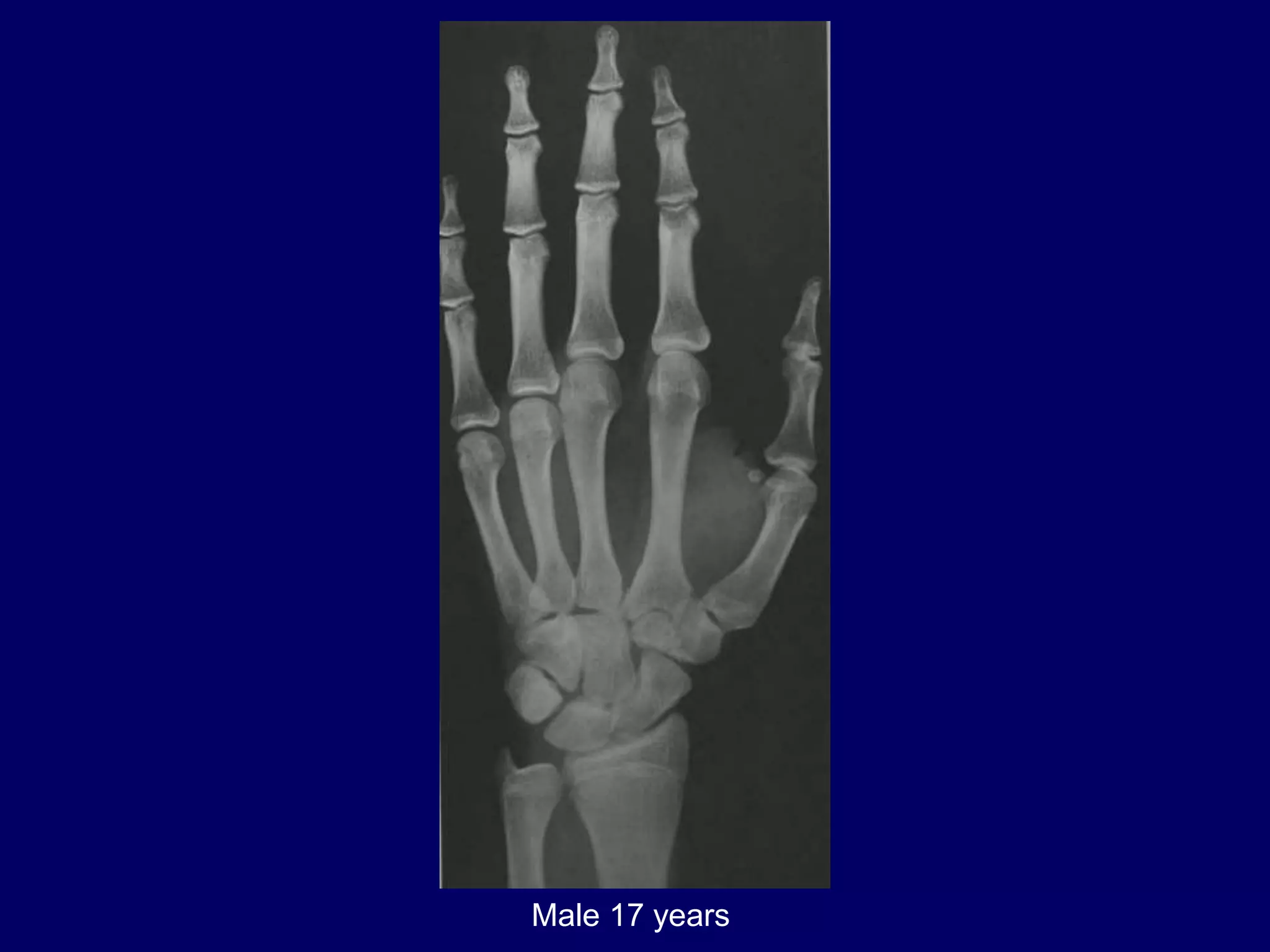 bone age .pptx