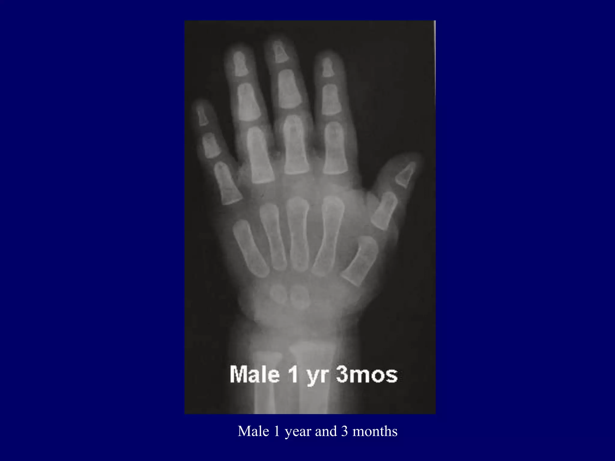bone age .pptx