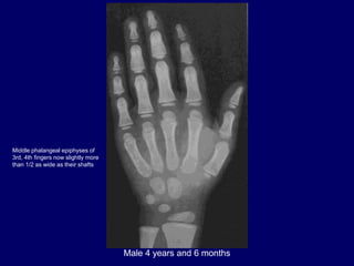 Male 4 years and 6 months
Middle phalangeal epiphyses of
3rd, 4th fingers now slightly more
than 1/2 as wide as their shafts
 