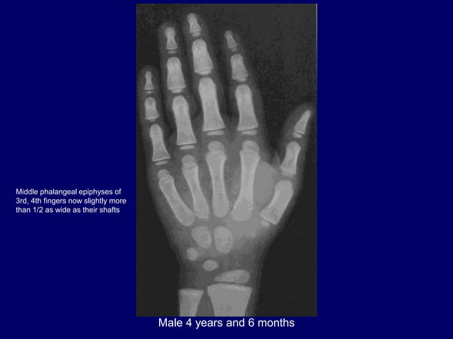 bone age .pptx