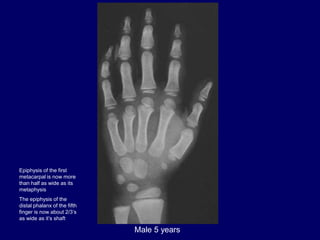 Male 5 years
Epiphysis of the first
metacarpal is now more
than half as wide as its
metaphysis
The epiphysis of the
distal...