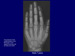 Male 7 years
The epiphysis of the
middle phalanx of the
fifth finger is now
slightly more than half
as wide as its shaft.
 