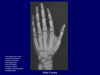Male 9 years
The distal ends of the
shafts of the second
and third proximal
phalanges have
become slightly
concave as thei...
