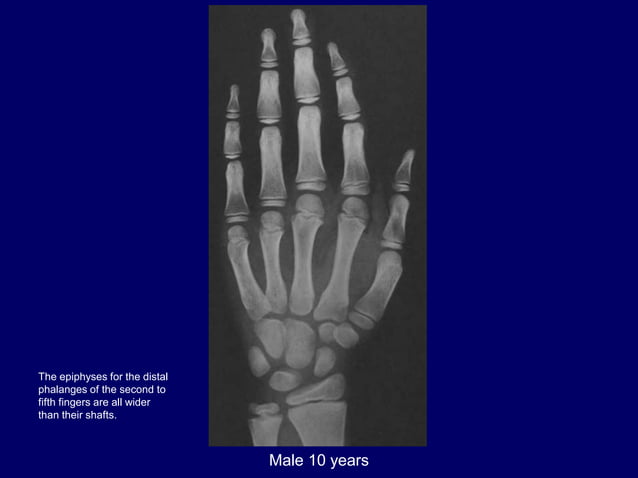 bone age .pptx