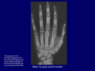 Male 12 years and 6 months
The epiphysis of the
proximal phalanges of the
3rd, 4th and 5th fingers and
of the middle phala...
