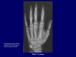 Male 13 years
The epiphysis of the middle
phalanx of the fifth finger is
now as wide as its shaft.
 