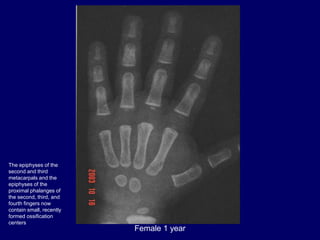 Female 1 year
The epiphyses of the
second and third
metacarpals and the
epiphyses of the
proximal phalanges of
the second,...