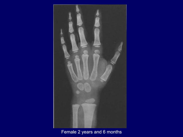 bone age .pptx