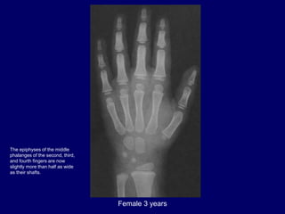 Female 3 years
The epiphyses of the middle
phalanges of the second, third,
and fourth fingers are now
slightly more than h...