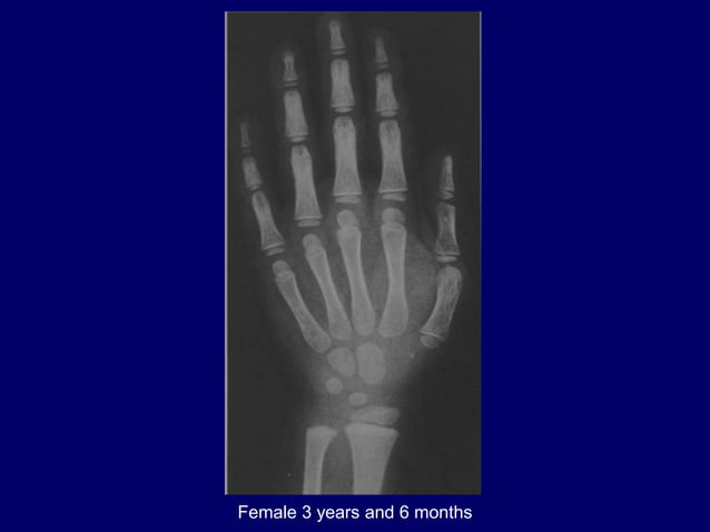 bone age .pptx