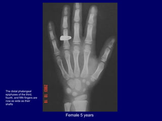 Female 5 years
The distal phalangeal
epiphyses of the third,
fourth, and fifth fingers are
now as wide as their
shafts
 