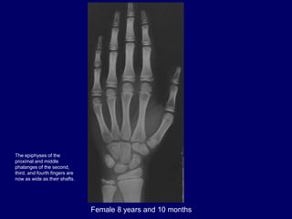 Female 8 years and 10 months
The epiphyses of the
proximal and middle
phalanges of the second,
third, and fourth fingers are
now as wide as their shafts.
 