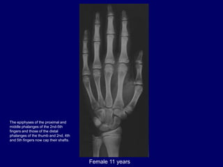 Female 11 years
The epiphyses of the proximal and
middle phalanges of the 2nd-5th
fingers and those of the distal
phalange...