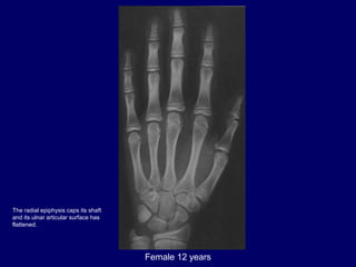 Female 12 years
The radial epiphysis caps its shaft
and its ulnar articular surface has
flattened.
 