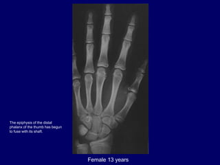 Female 13 years
The epiphysis of the distal
phalanx of the thumb has begun
to fuse with its shaft.
 