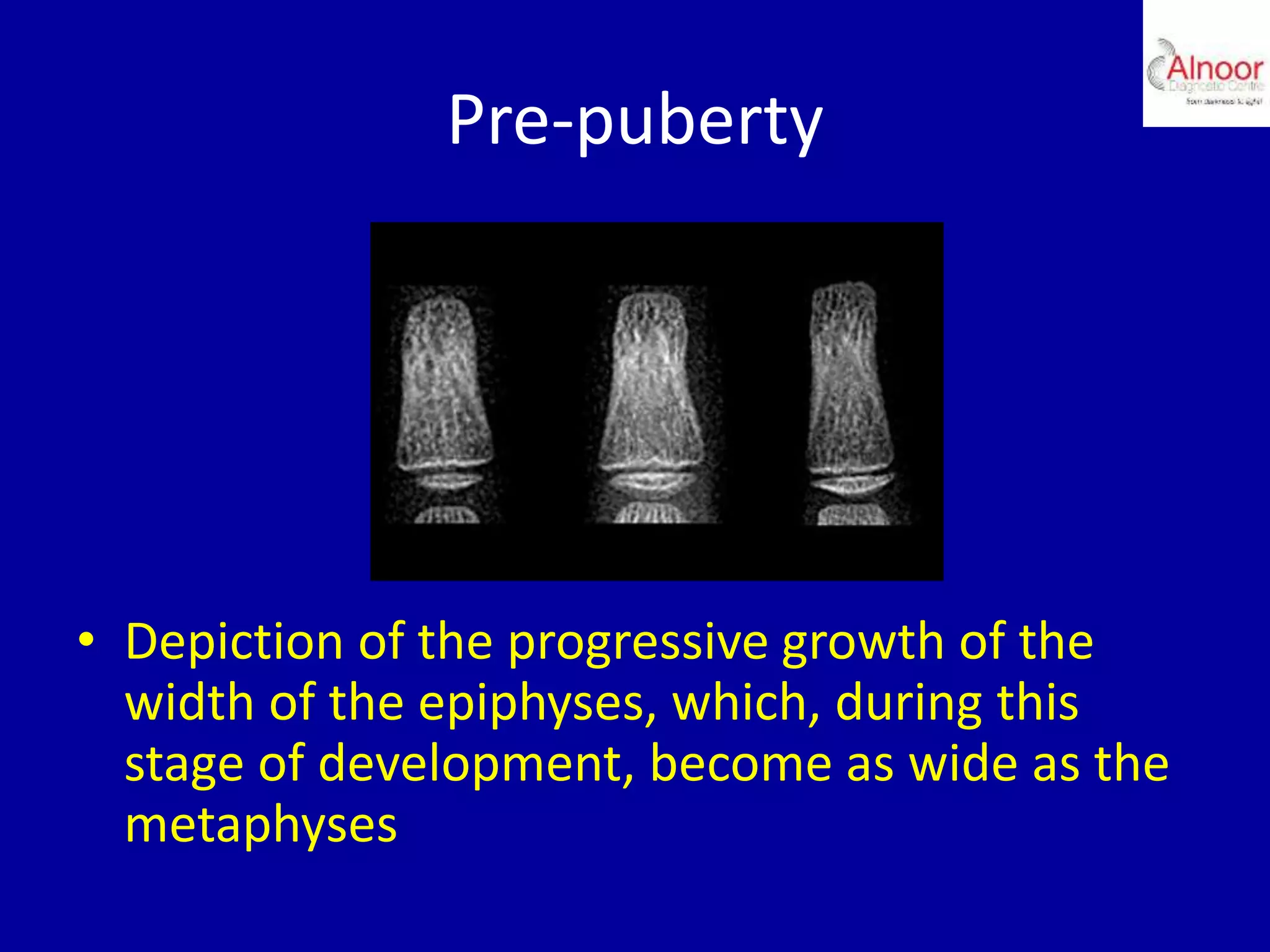Pre-puberty
• Depiction of the progressive growth of the
width of the epiphyses, which, during this
stage of development, become as wide as the
metaphyses
 