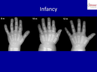 Bone age assessment | PPTX