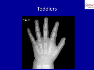 Bone age assessment | PPTX