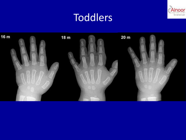 Bone age assessment | PPTX | Menopause | Endocrine and Metabolic Diseases