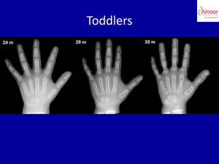 Bone age assessment | PPTX