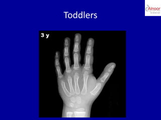 Bone age assessment | PPTX
