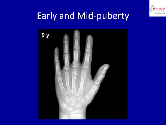 Bone age assessment | PPTX | Menopause | Endocrine and Metabolic Diseases