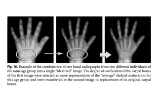 BONE AGE ASSESSMENT IN PEDIATRICS(1)-1.pptx