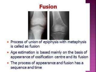 Bone age assessment dr ankita | PPTX