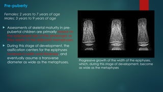 Bone age determination by assessment of skeletal maturity.pptx