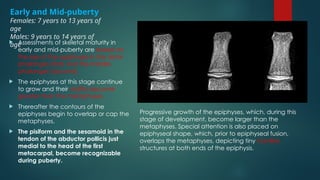 Bone age determination by assessment of skeletal maturity.pptx