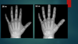 Bone age determination by assessment of skeletal maturity.pptx