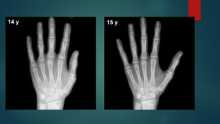 Bone age determination by assessment of skeletal maturity.pptx