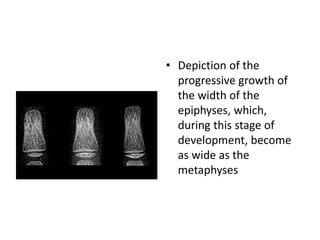 • Depiction of the 
progressive growth of 
the width of the 
epiphyses, which, 
during this stage of 
development, become 
as wide as the 
metaphyses 
 
