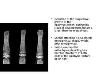 • Depiction of the progressive 
growth of the 
epiphyses,which, during this 
stage of development, become 
larger than the metaphyses. 
• Special attention is also placed 
on epiphyseal shape, which, 
prior to epiphyseal 
• fusion, overlaps the 
metaphyses, depicting tiny 
hornlike structures at both 
ends of the epiphysis (picture 
at far-right) 
 