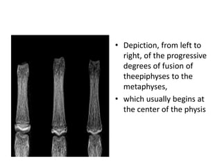 • Depiction, from left to 
right, of the progressive 
degrees of fusion of 
theepiphyses to the 
metaphyses, 
• which usually begins at 
the center of the physis 
 