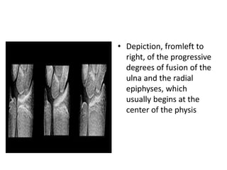 • Depiction, fromleft to 
right, of the progressive 
degrees of fusion of the 
ulna and the radial 
epiphyses, which 
usually begins at the 
center of the physis 
 