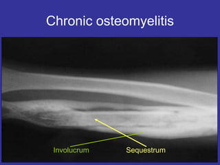 Bone and joint infect.ppt
