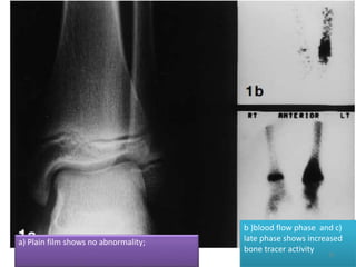 a) Plain film shows no abnormality;
b )blood flow phase and c)
late phase shows increased
bone tracer activity
25
 