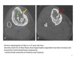 Chronic osteomyelitis of tibia in a 57-year-old man.
A and B, Axial CTs of tibia-fibula show hypertrophic expanded new bone (involucrum)
around the central dead bones (sequestra).
- cortical break anteriorly at fistulous tract (cloaca).
30
 