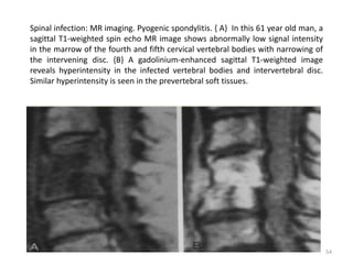 Spinal infection: MR imaging. Pyogenic spondylitis. { A} In this 61 year old man, a
sagittal T1-weighted spin echo MR image shows abnormally low signal intensity
in the marrow of the fourth and fifth cervical vertebral bodies with narrowing of
the intervening disc. {B} A gadolinium-enhanced sagittal T1-weighted image
reveals hyperintensity in the infected vertebral bodies and intervertebral disc.
Similar hyperintensity is seen in the prevertebral soft tissues.
54
 