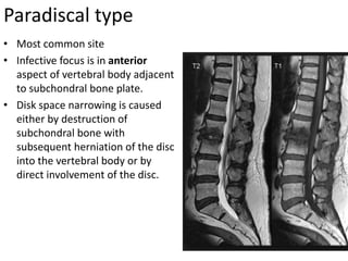 Paradiscal type
• Most common site
• Infective focus is in anterior
aspect of vertebral body adjacent
to subchondral bone plate.
• Disk space narrowing is caused
either by destruction of
subchondral bone with
subsequent herniation of the disc
into the vertebral body or by
direct involvement of the disc.
 